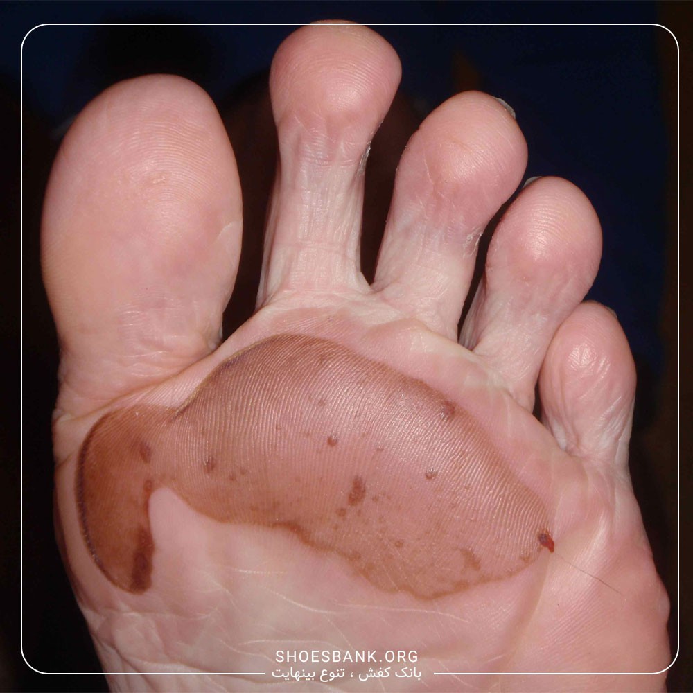 تاول گروهی دیابتی